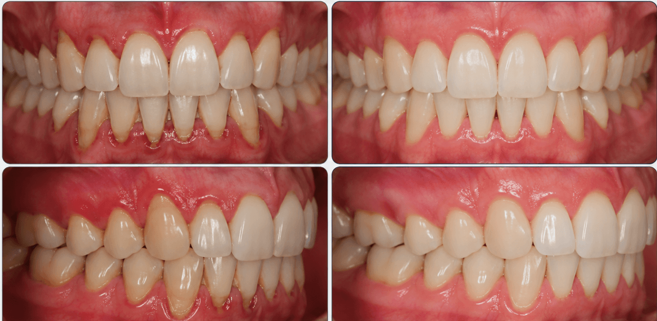 Caso clínico de periodontia e saúde gengival em Vitória da Conquista